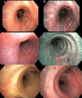 Frontiers Case Reports Bronchial Mucosal Vasculature Is Also